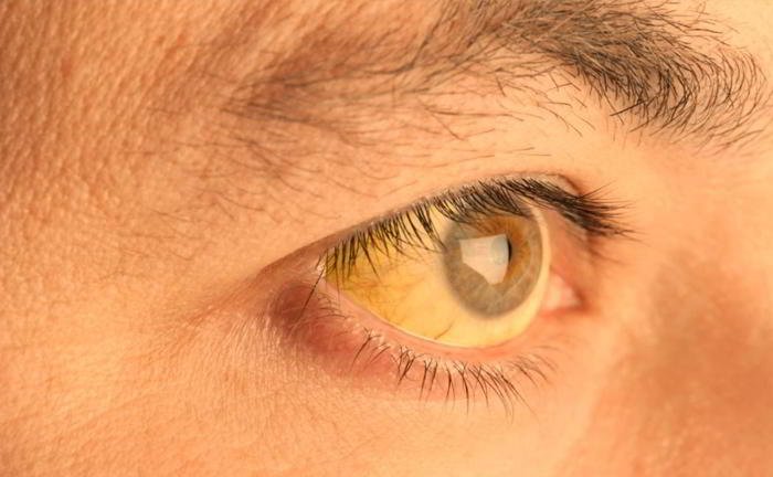 I have yellow patches around my eyes. What is the problem?