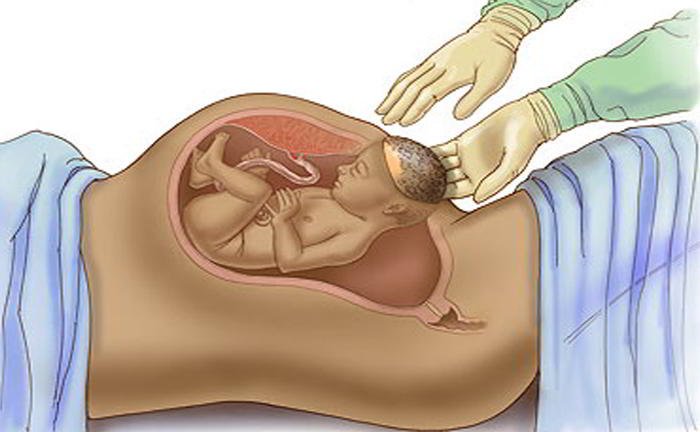 In what cases, caesarean is done?