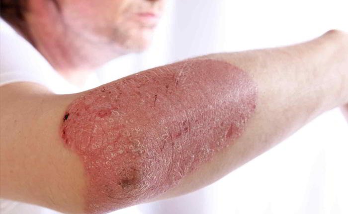 Is dermatitis contagious?