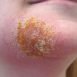 Is impetigo contagious?