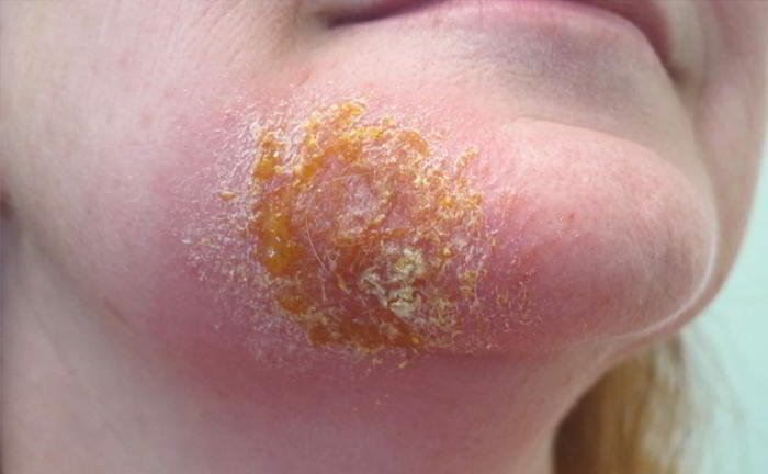 Is impetigo contagious?