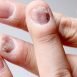 My nails are becoming cracked. What is the problem?