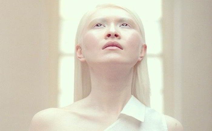 One of my friend is an albino. What is it?