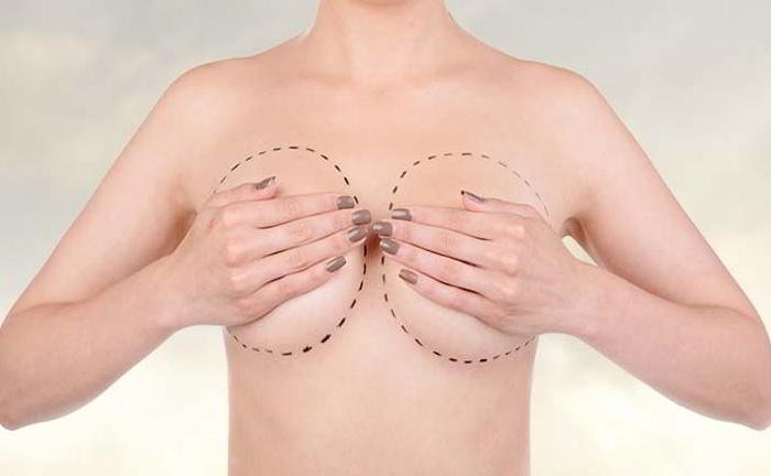 Please tell me about subcutaneous mastectomy?