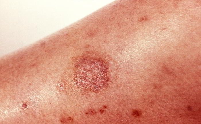 Should I take antibiotics in case of love bites?