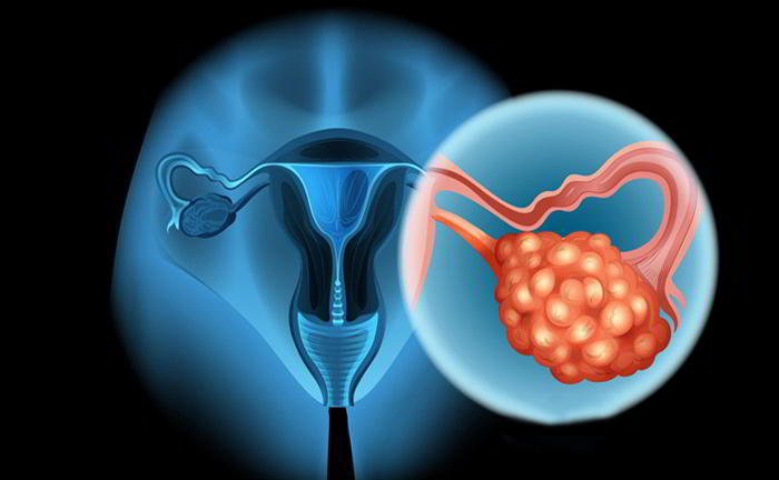 The doctor has asked me to get hysterectomy done. Do I really have to get it done?