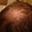 There is a bald patch on my fead. Why is it so?