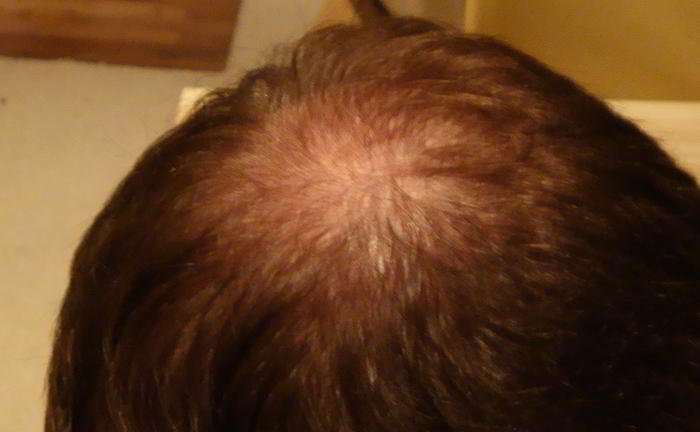 There is a bald patch on my fead. Why is it so?