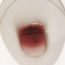 There is slight bleeding, when I pass my stool. Do I need to worry about it?