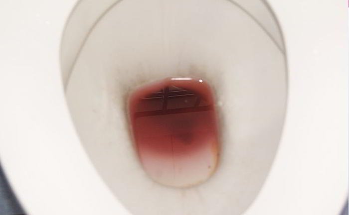 There is slight bleeding, when I pass my stool. Do I need to worry about it?