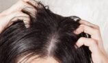 Top 5 remedies for eradication of dandruff