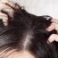 Top 5 remedies for eradication of dandruff
