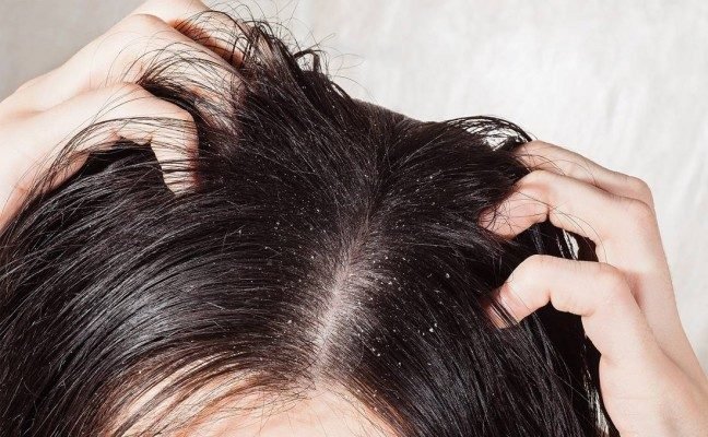 Top 5 remedies for eradication of dandruff