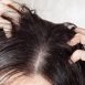 Top 5 remedies for eradication of dandruff
