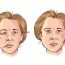 Top Homeopathic medicines for Bell’s palsy