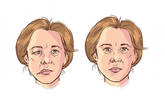 Top Homeopathic medicines for Bell’s palsy