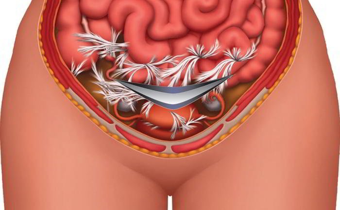 What are adhesions?