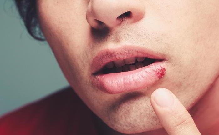 What are cold sores?