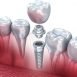 What are crowns made up of ?