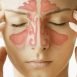 What are the symptoms of sinusitis ?