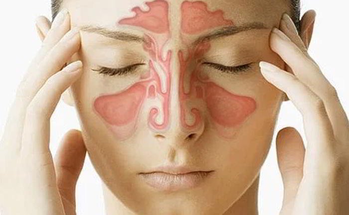 What are the symptoms of sinusitis ?