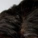 What causes dandruff?