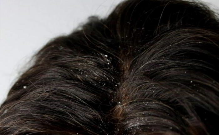 What causes dandruff?