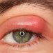 What is a stye?