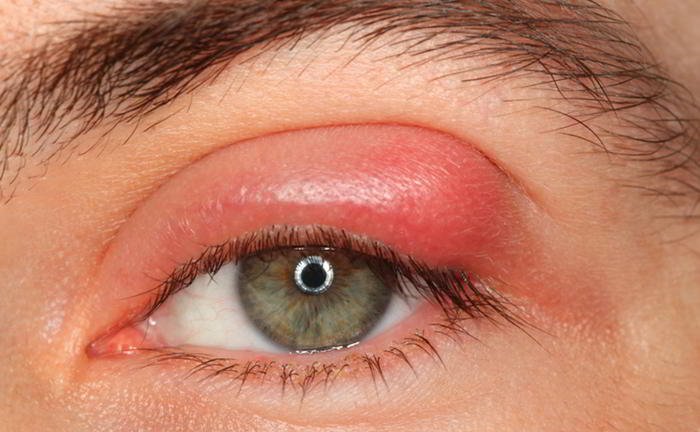 What is a stye?