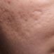 What is acne?