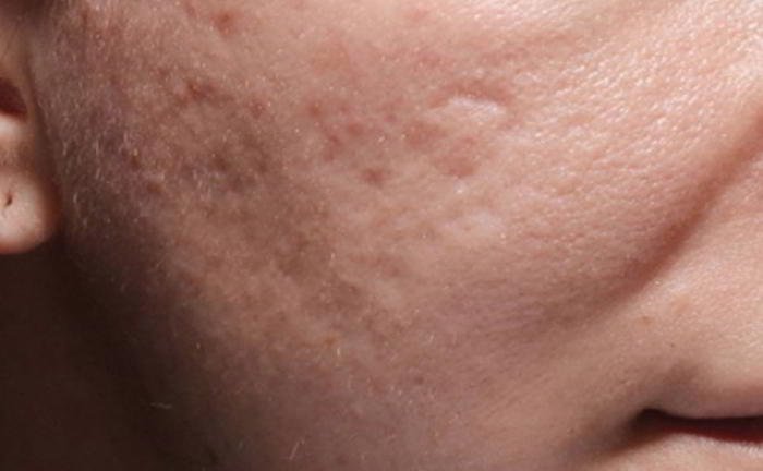 What is acne?