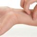 What is allergic dermatitis?