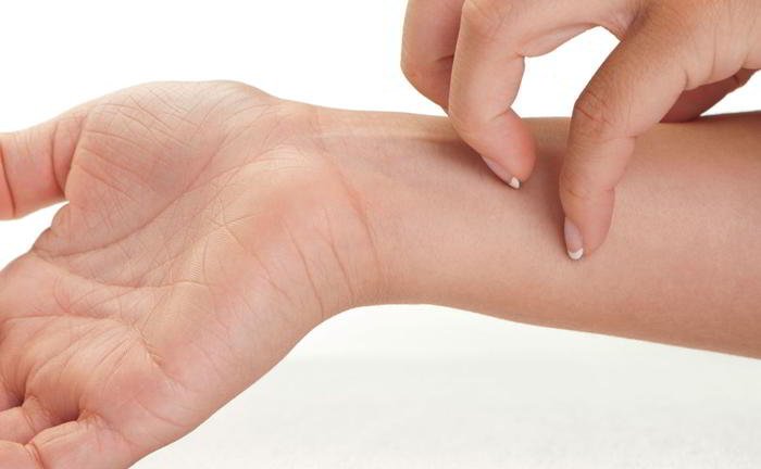 What is allergic dermatitis?