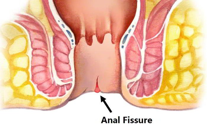 What is anal fissure?