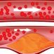 What is angina and what causes it?