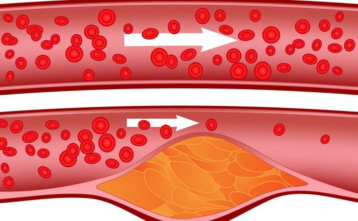 What is angina and what causes it?