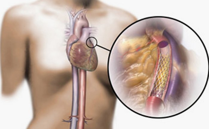 What is angioplasty?