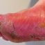 What is athlete's foot?
