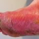 What is athlete's foot?