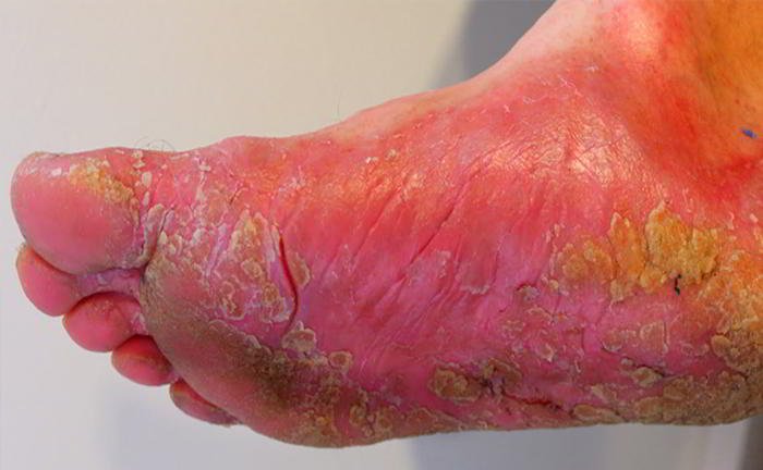What is athlete's foot?
