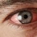 What is cataract?