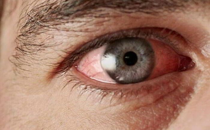 What is cataract?