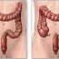 What is colostomy and ileostomy?