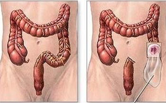 What is colostomy and ileostomy?