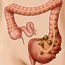 What is diverticulitis?