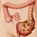 What is diverticulitis?