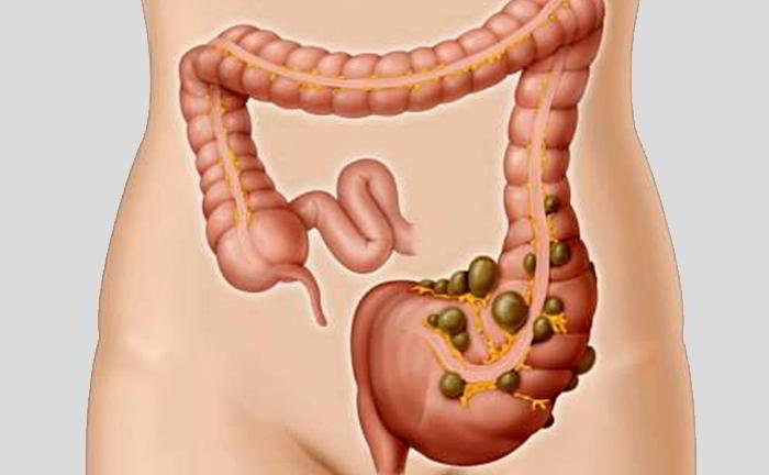 What is diverticulitis?