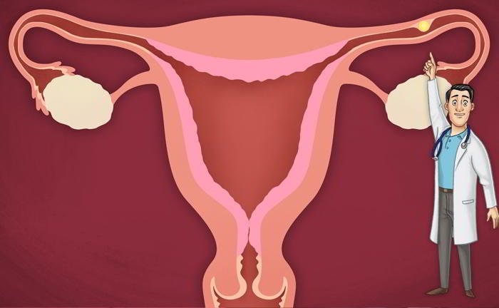 What is ectopic pregnancy?
