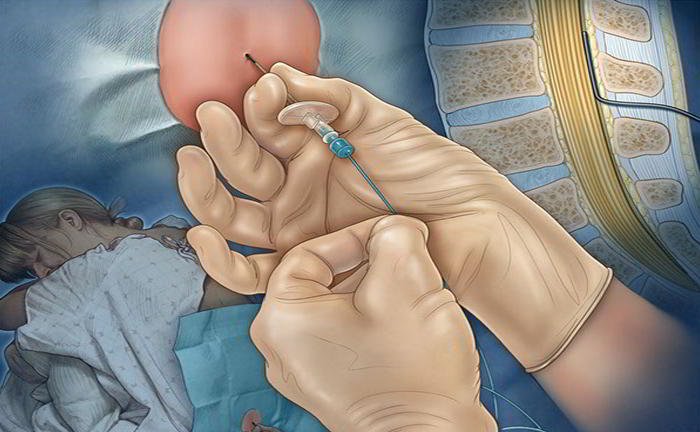 What is epidural analgesia?
