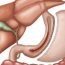 What is gastrectomy?